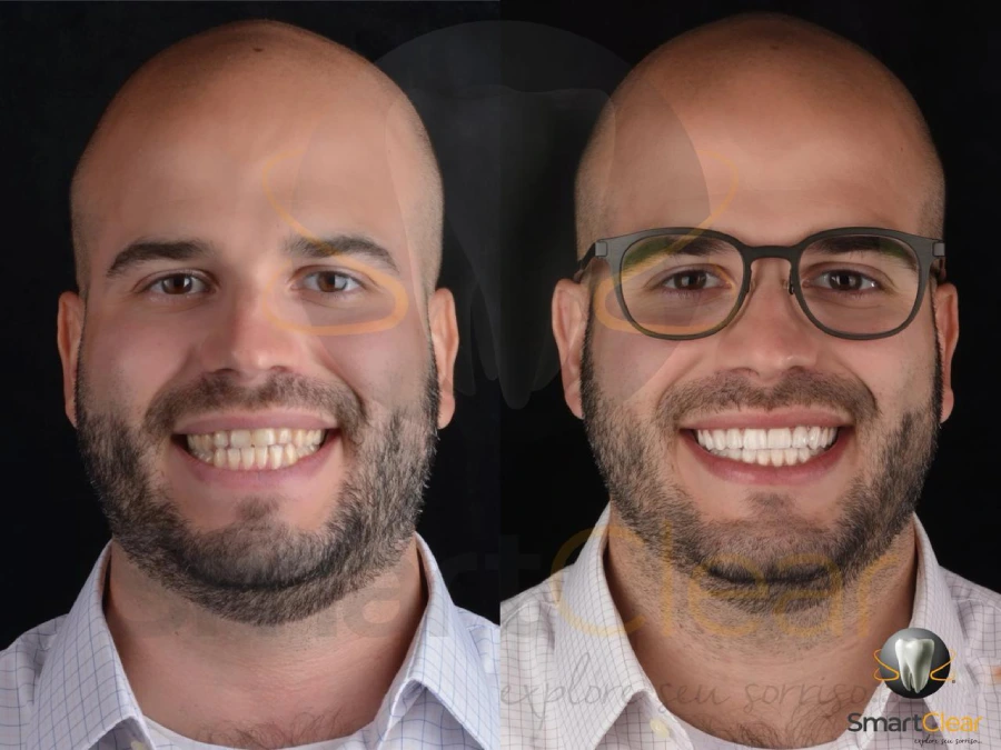 Lentes de contato dental